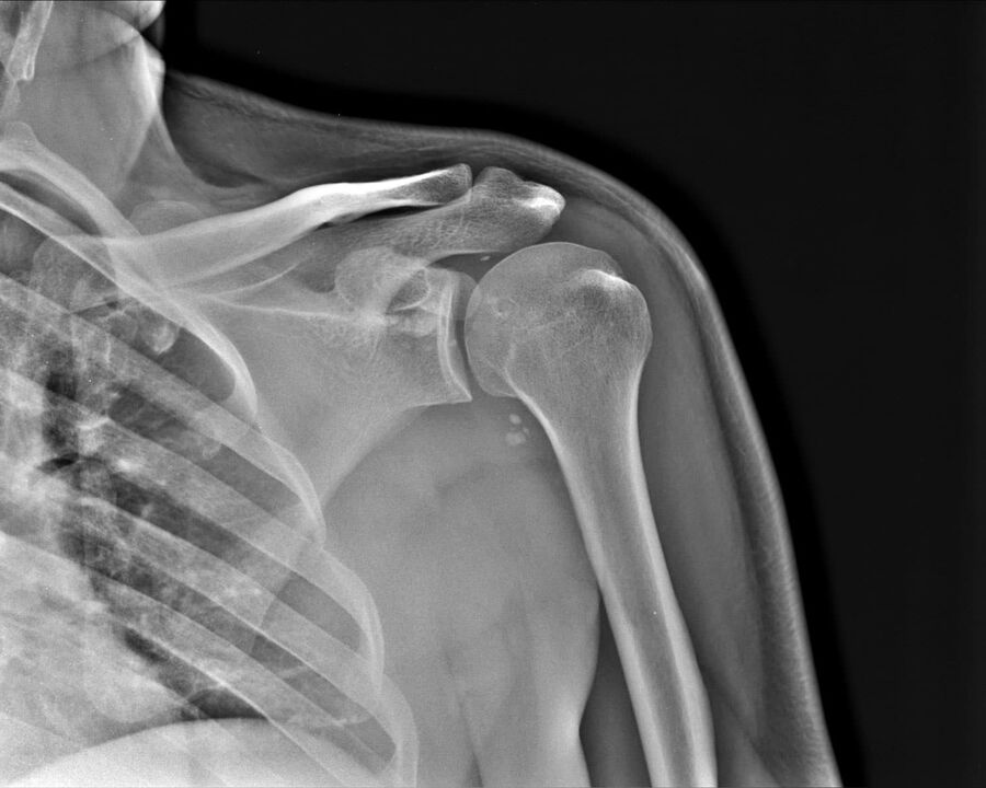X-ray of arthrosis of the shoulder joint of the 2nd degree of severity