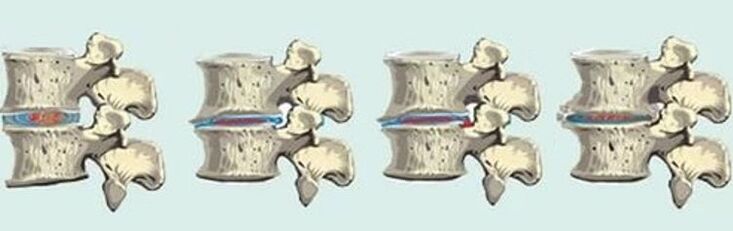 spinal injury in case of thoracic osteochondrosis
