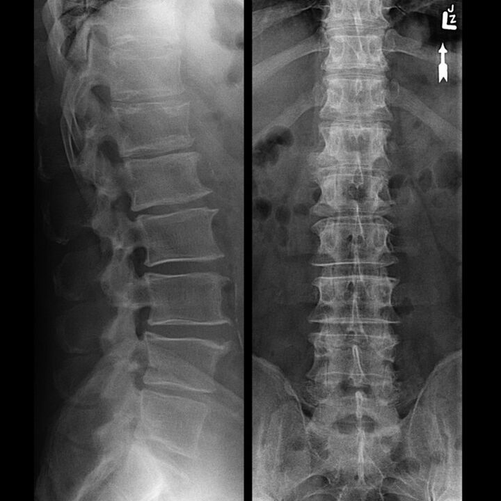 X-ray of the thoracic region, showing a decrease in the space between the vertebrae along the spine from bottom to top