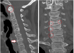 CT shows damaged vertebrae and discs of heterogeneous height due to thoracic osteochondrosis