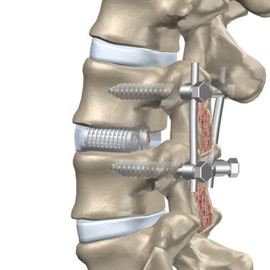 Replacement of a destroyed disc of the thoracic spine with an artificial implant