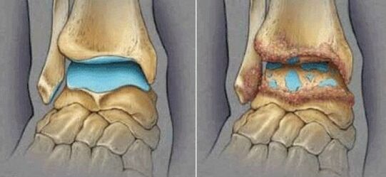 healthy osteoarthritis of the joint and ankle