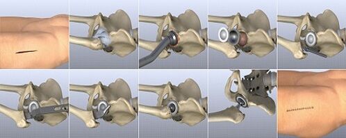 methods of treatment of hip arthrosis