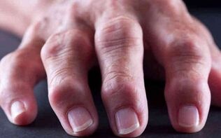 rheumatoid arthritis as a cause of joint pain